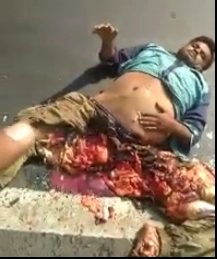 Shocked Man Still Alive With Lower Half Turned to Mincemeat