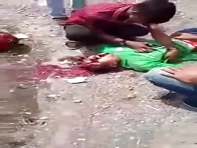 Face Torn in Accident