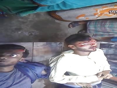 Eye Popped After Crash