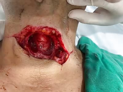 Accident man with big cut on his throat