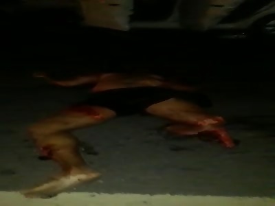 shocking amputated leg accident