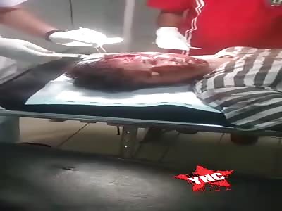 Victim of serious vehicular accident. 