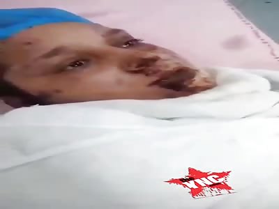 Woman burned by her in laws