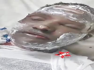 Young remains alive after being burned