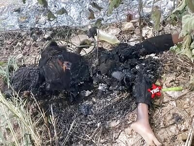 Woman burned to the bone