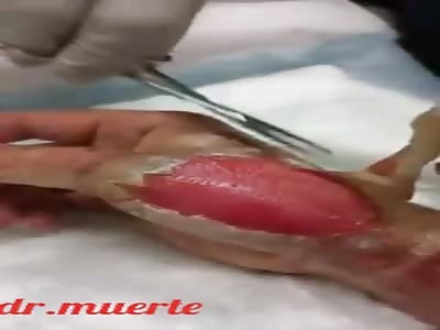 Medical assistance burns