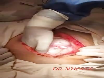 giant tumor in ovary