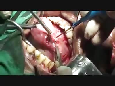 removing part affected by cancer in the tongue