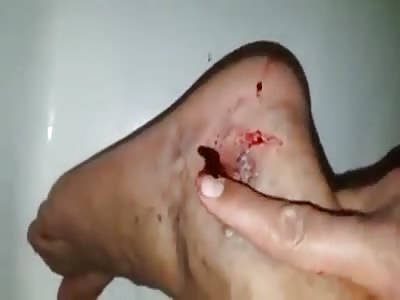 broken artery! bleeding