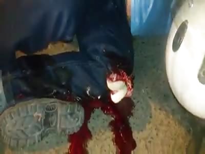 the man has his knee exposed, after a tragic motorcycle accident