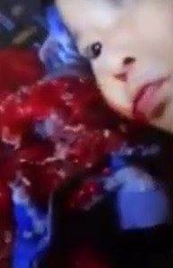 Rare disease that causes vomiting of blood