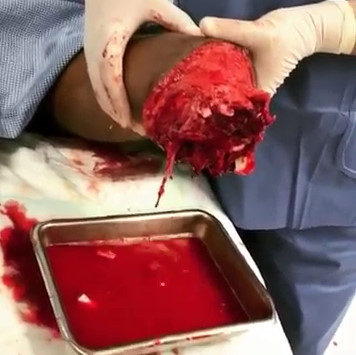Accident leading to limb loss control of severe blood loss