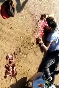 Shattered skull after Accident 