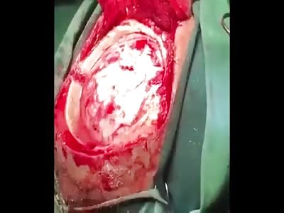 Brain surgery, gelatin.