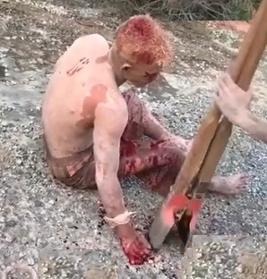 They Took a Little More Than His Fingers...