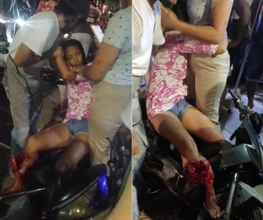 Horrible Leg Hanging By String and Bone Exposed... Woman In Total Shock [CCTV & Aftermath]