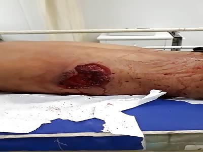 Still Breathing with a Hole in His Ribs