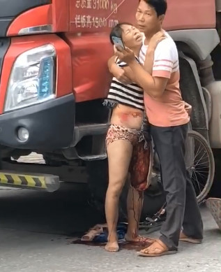 Woman's Leg Completely Skinned To The Bone In Total Shock