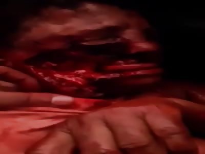 Accident Victim with Severe Facial Trauma Clings to Life. 