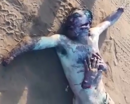 Man Left With Hands Amputated