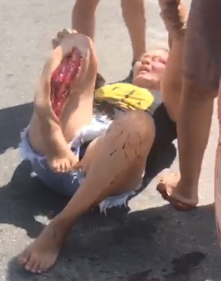 Woman Broken In Accident Screams In Pain