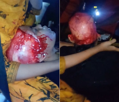 She Will Never Have Her Natural Hair: Fully Scalped Woman Is Awake & Shocked