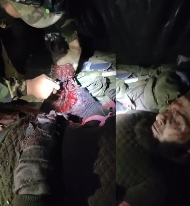 Chechen Soldier Gets Amputated What Left of His Palm