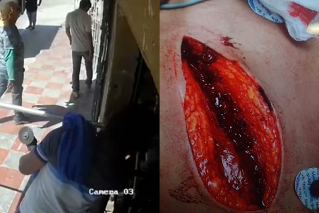 Painful Day At Work In Colombia (Action & Aftermath)