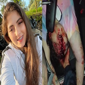 Woman Splits Her Face In Half After She Flips Over In Her Trailer 