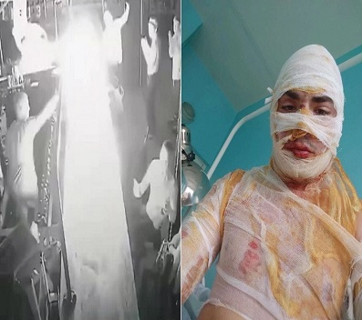 Bartender Encourages Drunkard to Stop Drinking by Burning His Face