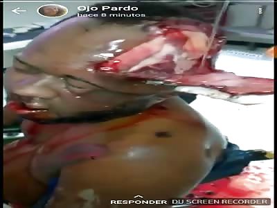 Cut by machete Scalped to the Skull  in hospital 