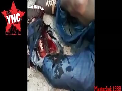 Accident injured leg (longer version)