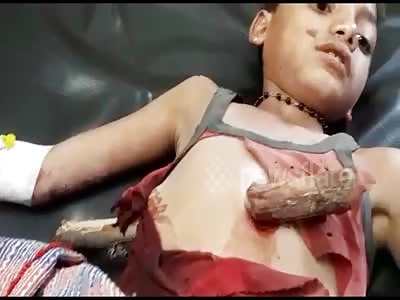 A boy seriously injured after wooden log pierced through stomach...