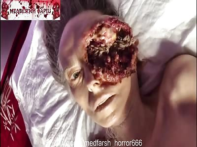 What Eye Lid Cancer Looks Like