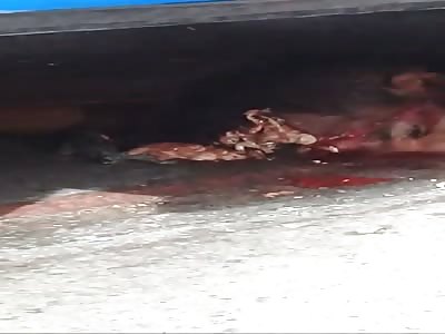 shattered skull after accident