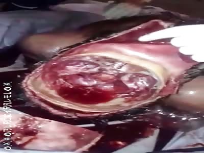 Autopsy done in an unprofessional way