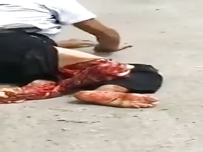 Possibly the most Gruesome Leg Trauma Ive Ever Seen.