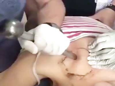 Chinese Chiropractor Chiseling A Patient's Spine