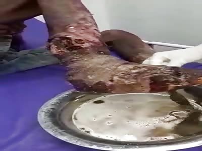 WTF  , man with totally rotten foot