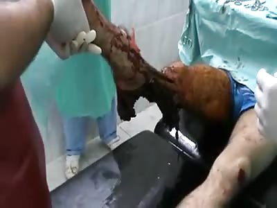 Broken Wounded Leg Attached With A Skin Only