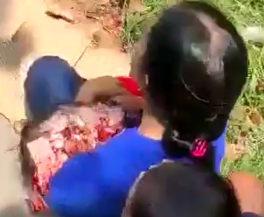 Kids Skull Crushed In Accident