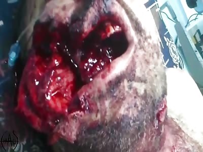 Head Trauma Compilation