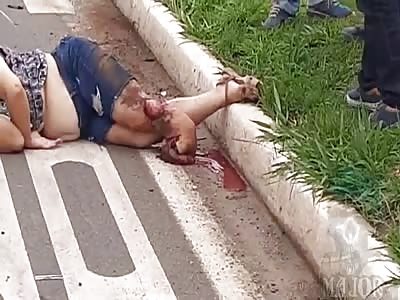 woman has amputated leg in accident