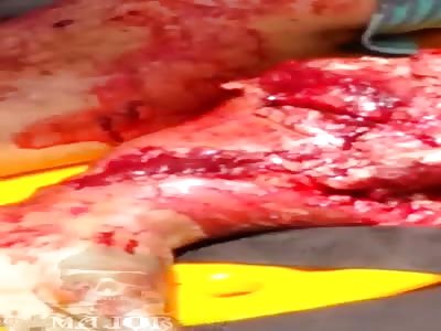 Man have smashed leg in accident