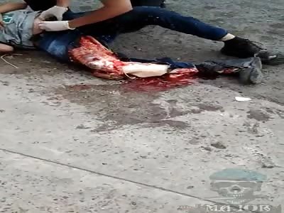 leg smashed in terrible accident