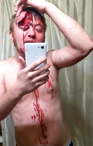 Dude Cracks Forehead in Car Crash, Films Exposed Skull