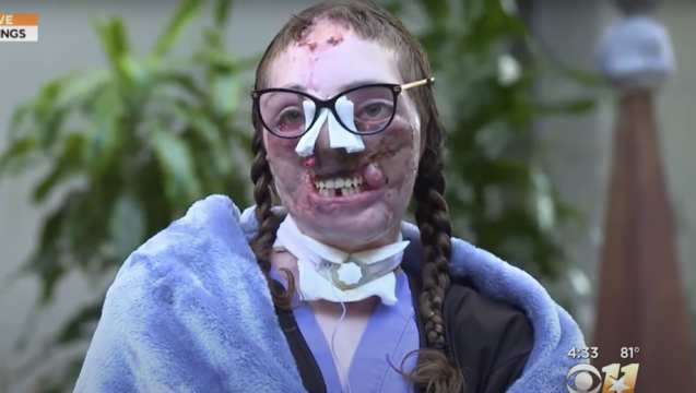 Dog Sitter Mauled & Bit Over 800 Times (Lost Her Nose, Lips