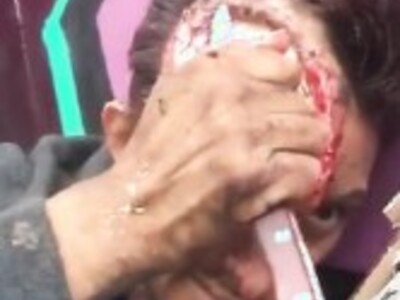 SAD: Homeless Guy Scrapes away Rotting Skin..