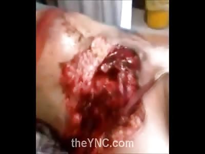 Man in Total Agony Laying on a Table with Chest Split Open and Heart Exposed