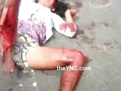 OH HELL.....Poor Woman with Nasty Leg Break has her Foot Flopping around